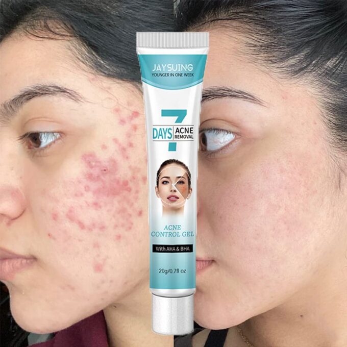 Crema tratamiento acne mascarilla facial FK23B-39