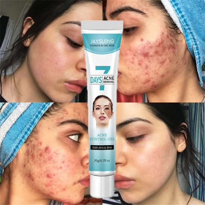 Crema tratamiento acne mascarilla facial FK23B-39